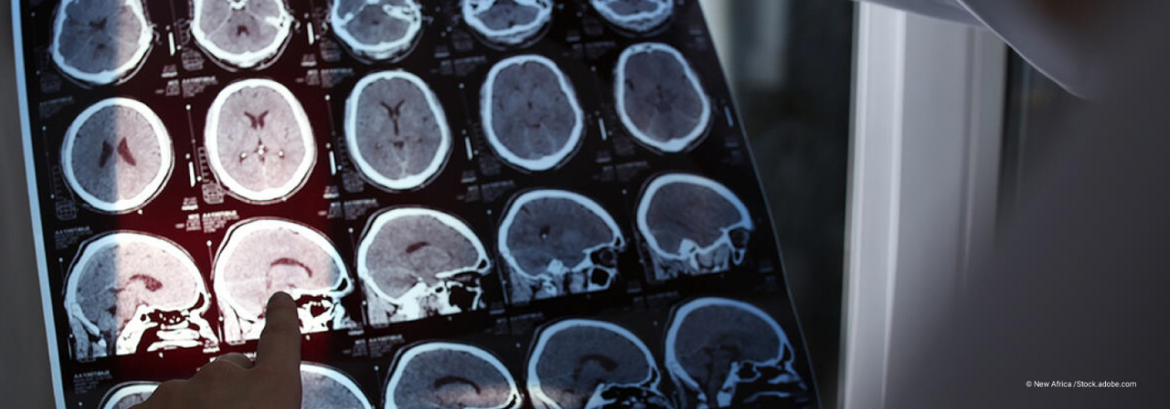 Un médecin examine les images IRM d'un patient atteint de sclérose en plaques, maladie auto-immune et neurodégénérative qui touche le cerveau et la moelle épinière.