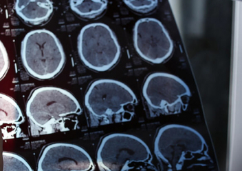 Un médecin examine les images IRM d'un patient atteint de sclérose en plaques, maladie auto-immune et neurodégénérative qui touche le cerveau et la moelle épinière.