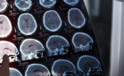 Un médecin examine les images IRM d'un patient atteint de sclérose en plaques, maladie auto-immune et neurodégénérative qui touche le cerveau et la moelle épinière.